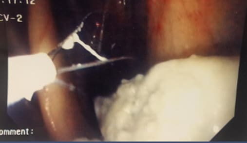 An endoscopic view shows a veterinarian skillfully removing a white, cloudy mass from within a body cavity, possibly during a surgical or diagnostic procedure at a pet clinic.